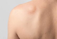Липома на спине: удаление, лечение, причины, операция
