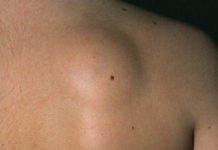 Удаление липомы: лазером, радиоволновым методом, хирургическим путем