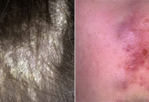 Сыпь при ВИЧ