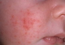 Сыпь у грудничка: фото и описание высыпаний у новорожденного