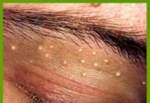 Жировики на веках: причины появления и как от них избавиться