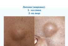 Прыщ жировик — как избавиться, причины появления на лице