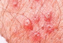 Высыпания на половых губах у женщин: фото, красные и белые