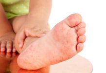 Сыпь на ладонях и ступнях ребенка — причины с фото и лечение