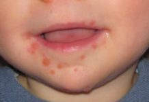 Сыпь у рта ребенка — фото, все причины и лечение