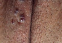 Гнойнички на половых губах: симптомы и признаки