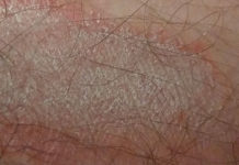 Сыпь на члене: причины появления, список ЗППП вызывающих высыпания на головке пениса