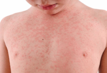 Сыпь на груди у ребенка: причины, фото, лечение