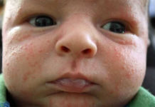 Сыпь на лице у новорожденного — виды, методы лечения