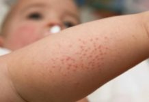 Сыпь на ногах у ребенка (31 фото): причины красной мелкой сыпи с пояснениями, без температуры на щеках у грудного ребенка