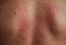 Cыпь на спине у взрослого: красные пятна и высыпания, почему появились прыщи и чешутся – причины