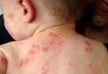 Сыпь на спине у ребенка (20 фото): причины красных высыпаний — пояснения