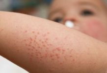 Сыпь на теле у ребенка