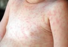 Сыпь на животе у ребенка (29 фото): причины с пояснениями, мелкая и красная, после высокой температуры