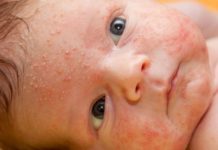 Сыпь на лице и шее у новорожденных