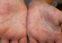 Сыпь при менингите: нужно уметь вовремя опознать