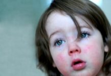 Сыпь при скарлатине (13 фото): какая сыпь и где располагается