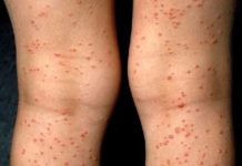 Сыпь при ВИЧ |