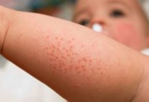 Сыпь у ребенка на руках и ногах, по всему телу — причины и последствия