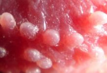 Гранулы Фордайса на губах и крайней плоти: лечение себорейных кист |