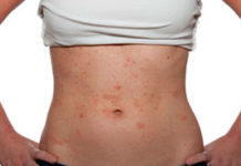 Кожная сыпь у взрослых: разбираем причины с фото, определение кожной сыпи