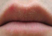 Почему образуются белые точки на губах под кожей, их виды и лечение