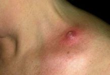 Фурункулы на теле: причины появления чирея, лечение лекарствами в домашних условиях |