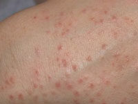 Высыпания на руках в виде красных прыщиков и точек: причины, методы устранения |