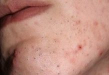Как вылечить угревую сыпь