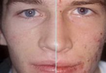 Угревая сыпь домашнее лечение | Травник