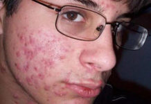 Угревая сыпь на лице: причины образования и лечение, виды прыщей