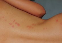 Как выглядят укусы клопов: подробное описание и фотографии