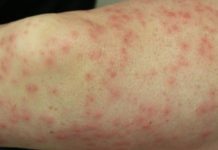 Сыпь на бедрах — все 4 причины с фото и как лечить их