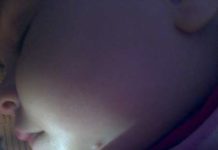 Жировики на лице у ребенка: причины появления липом, как избавиться от них или пройдут самостоятельно |