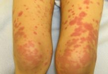 Васкулит, что это такое? Фото и внешние проявления болезни