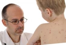 Как выглядит ветрянка: фото, начальная стадия, в легкой форме, сыпь и прыщи при ветрянке