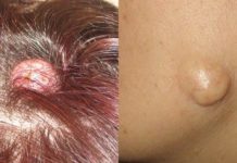 Липомы на теле: причины, как избавиться, удаление