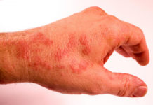 Виды высыпаний на ладонях и руках у ребенка и взрослого: фото и причины