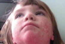 Сыпь после температуры и больше ничего — это детская розеола — Диагностер