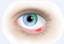 Внутренний ячмень на глазу: причины мейбомита верхнего и нижнего век, как лечить острое и хроническое восполение