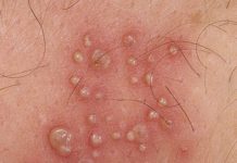 Водянистые пузырьки на коже у взрослых и ребенка (фото)