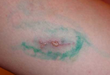 Водянистые пузырьки на коже: фото, причины, лечение | Заболевания кожи