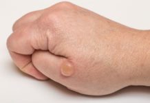 Волдыри на руках: мелкие на пальцах, ладонях, с жидкостью, красные