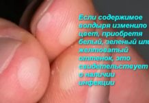 Волдыри на пальцах рук: причины, лечение, профилактика