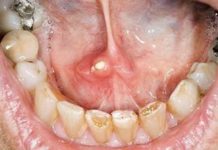 Болячка под языком, язвочки на уздечке: причины, лечение народными методами