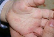 Сыпь между пальцами рук у ребенка; Как вылечить аллергию