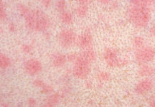 Вторичный сифилис — причины, симптомы, диагностика и лечение