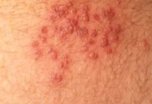 Высыпания на лобке и в зоне паха: причины, фото, лечение