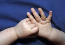 Сыпь у ребенка на ладошках и ступнях в виде пузырьков: фото, причины