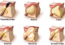 Высыпания на лбу у женщин